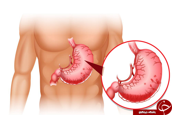 رایج ترین علائم زخم معده چیست و چه زمانی باید به پزشک مراجعه کرد؟