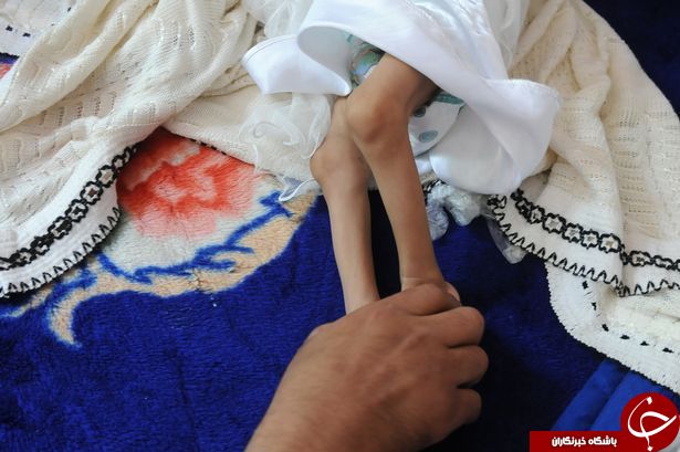 تصاویری دردناک از کودکان قحطی زده یمن