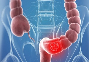(دریافتی)طراحی نانورآکتور آلی_فلزی موثر در درمان سرطان روده بزرگ