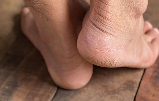 چرا کف پاهایمان زبر می شود؟