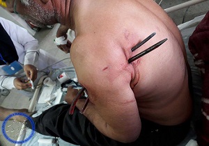 خارج کردن چنگک ۲۵ سانتی متری از بازو و شانه یک مرد میانسال + عکس