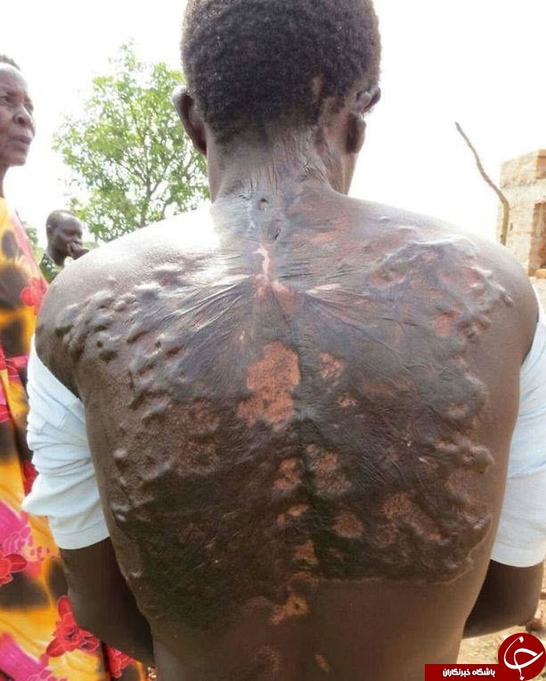 اصابت صاعقه با بدن انسان چه کار می کند! + تصاویر