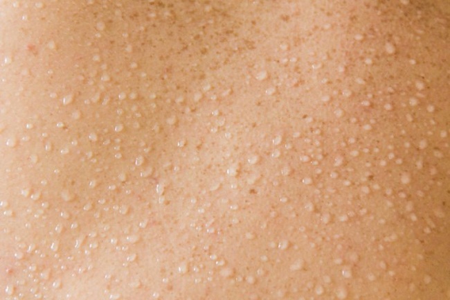 این ده عارضه پوستی را جدی بگیرید/چه زمانی باید به پزشک مراجعه کرد؟