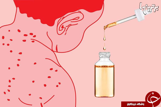 فوایدی روغن درخت چای که نمی&zwnj;دانید