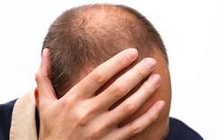 علل ریزش مو در افراد چیست؟+اینفوگرافیک