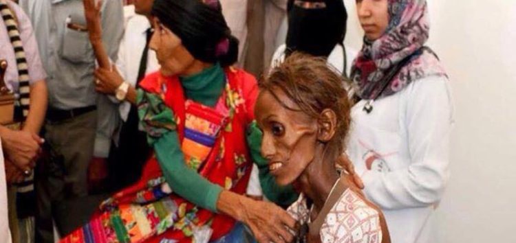 سازمان ملل: یمن به محل بروز بدترین فاجعه انسانی جهان تبدیل شده است