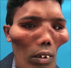 تغییر عجیب صورت مرد جوان در اثر یک بیماری نادر!+ فیلم//