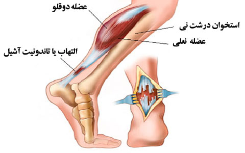 ورزشهای مناسب برای درمان پارگی تاندون آشیل+ تصاویر ورزشهای مناسب برای درمان پارگی تاندون آشیل+ تصاویر