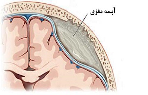 قارچ&zwnj;هایی که در مغز به دلیل عفونت رشد می&zwnj;کنند/دمل&zwnj;های چرکی در مغز را در نطفه خفه کنید