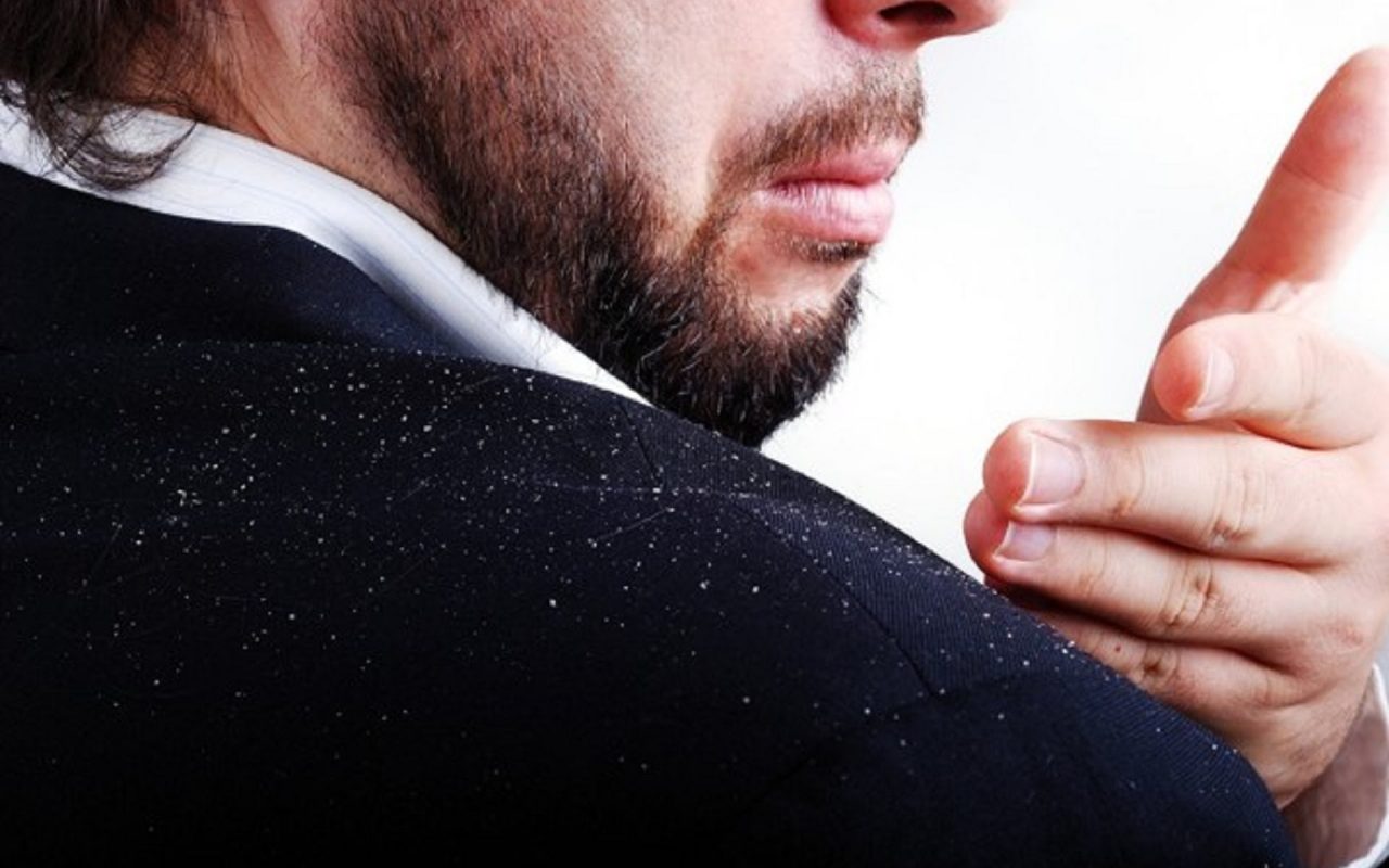 چرا  سرمان  شوره می زند؟