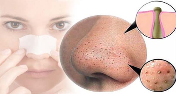 چگونه جوش های سرسیاه را از بین ببریم؟