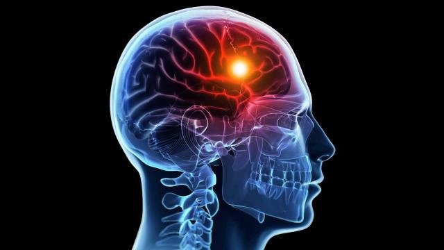 چگونه یک سکته مغزی را تشخیص دهیم؟