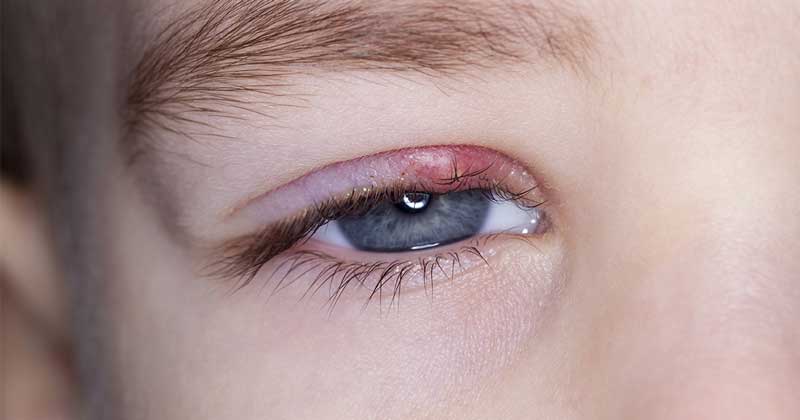 چگونه گل مژه را از بین ببریم؟