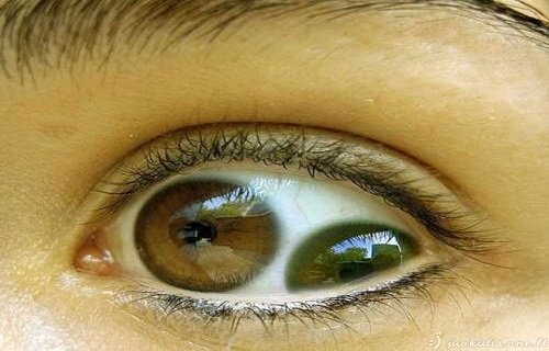 چشم دو مردمکی؛+ تصاویر چشم دو مردمکی؛+ تصاویر