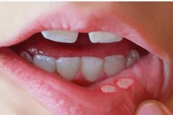دلایل ابتلا به سرطان دهان/ کدام زخم‌های دهانی خطرناک هستند؟