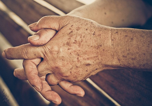 نسخه یک متخصص پوست&zwnj;و مو برای  خلاصی از شر لکه&zwnj;های قهوه&zwnj;ای پوست