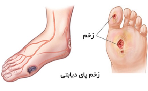 قاتل شیرین یا قند تلخ