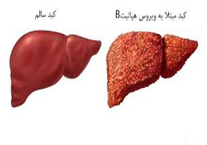 کاهش چشمگیر هپاتیت ب. در افراد زیر ۲۵ سال