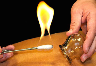 هر آنچه باید درباره بادکش&zwnj;درمانی بدانید