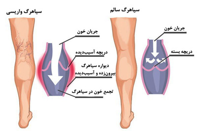 ورزش&zwnj;های مناسب برای درمان رگ&zwnj;هلی واریسی+ تصاویر