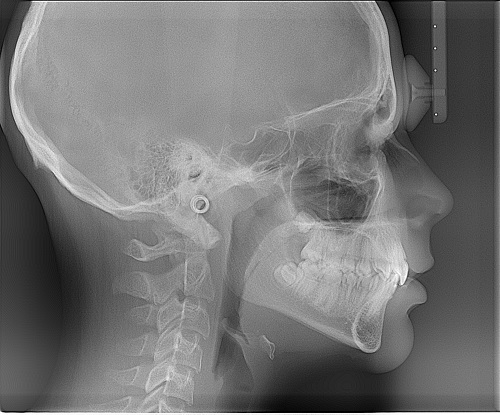 خستگی اولین علامت MS / منظور از ایجاد ترمیم در سیستم عصبی چیست؟