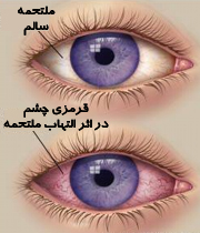 علت قرمزی چشم و خطرات ناشی از آن
