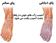 هر ۱۹ ثانیه در جهان، پای یک دیابتی قطع می&zwnj;شود&zwnj;