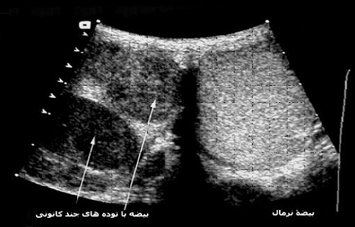 نگهداری سلول&zwnj;های بنیادی خون محیطی در کدام بیماری&zwnj;ها توصیه می&zwnj;شود؟