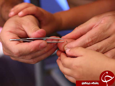 روشی ساده برای خارج کردن تراشه&zwnj;های فرو رفته در پوست که حتی فکرش را هم نمی&zwnj;کنید