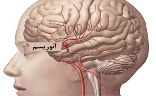 درمان ضایعات عروقی مغز به کمک رادیولوژی مداخله&zwnj;ای