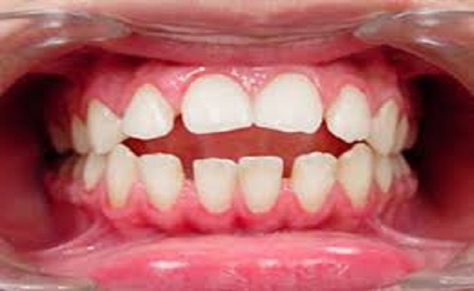 سن طلایی برای درمان ناهنجاری&zwnj;های فکی/ چه موقع پیش از جراحی، ارتودنسی باید انجام شود؟