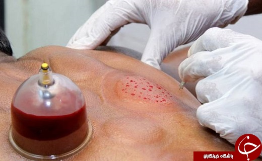 پاکسازی بهاری بدن به کمک روش&zwnj;های مختلف خون&zwnj;گیری / فرمول طب سنتی برای مهار بیش فعالی کودکان