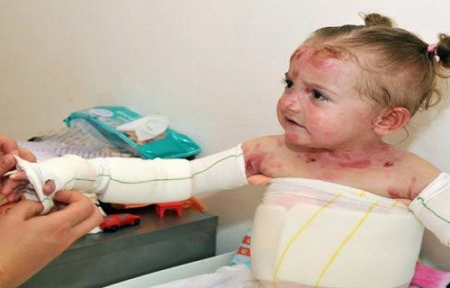 وجود ۴۰۰ مورد بیماری پروانه&zwnj;ای در کشور/ ژن درمانی اصلی&zwnj;ترین روش درمان بیماری پروانه&zwnj;ای