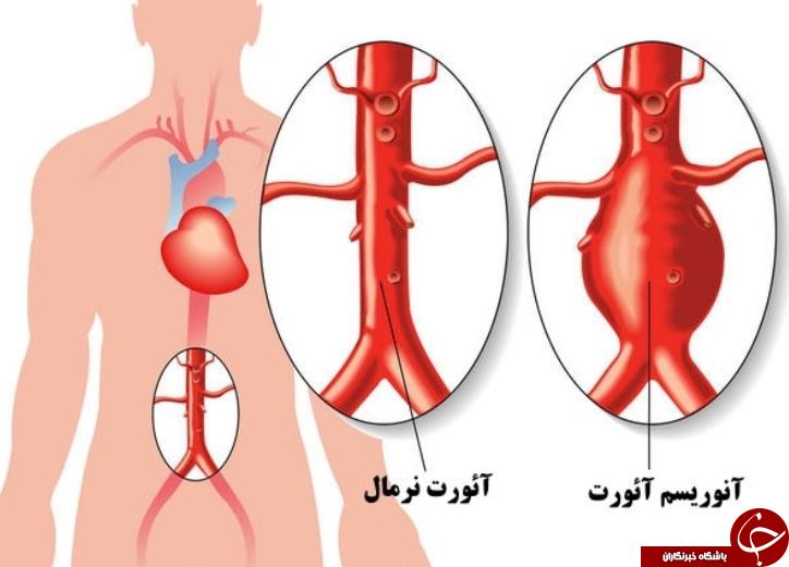 همه آنچه درباره آنوریسم آئورت شکمی  نمی دانید!