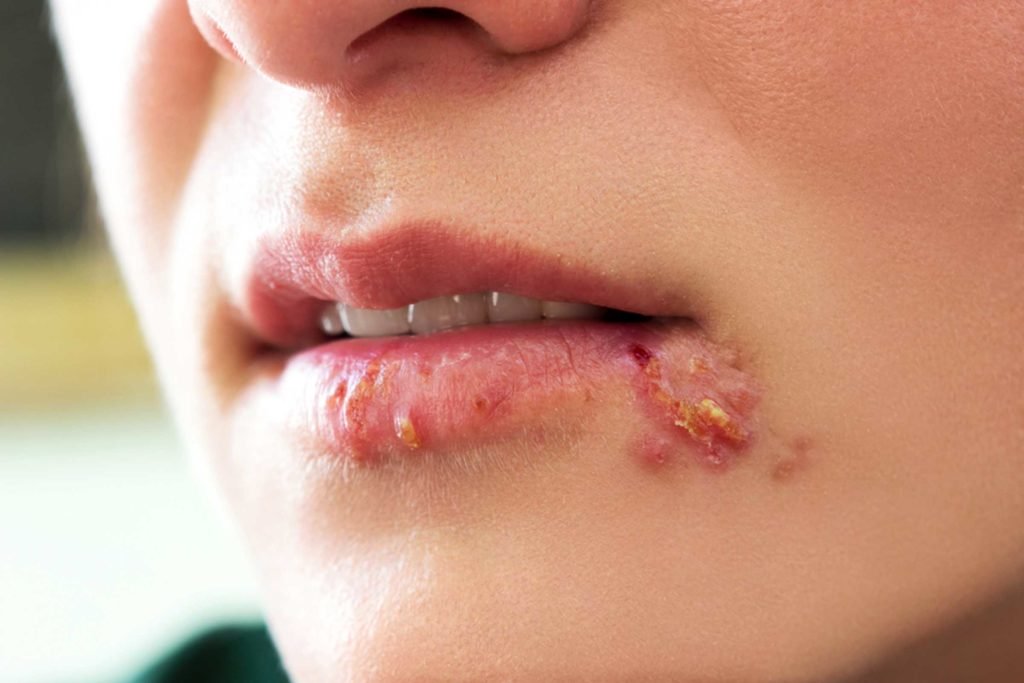 راه های مقابله با تب خال
