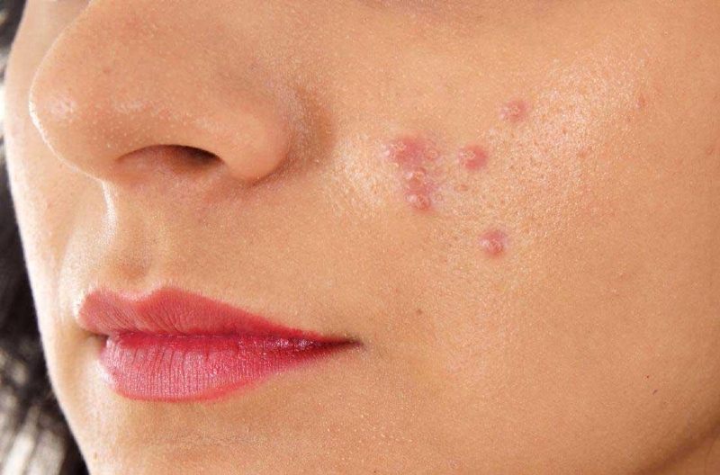 با این ۷ ماده غذایی به جنگ جوش ها بروید