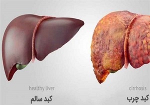 از علائم کبد چرب تا راه‌ های درمان