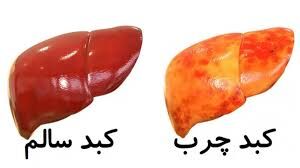 شیوع ۲ برابری کبد چرب در کشور