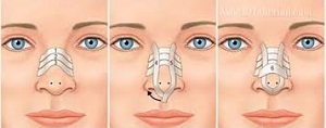 بعد از عمل بینی چگونه حمام کنیم؟