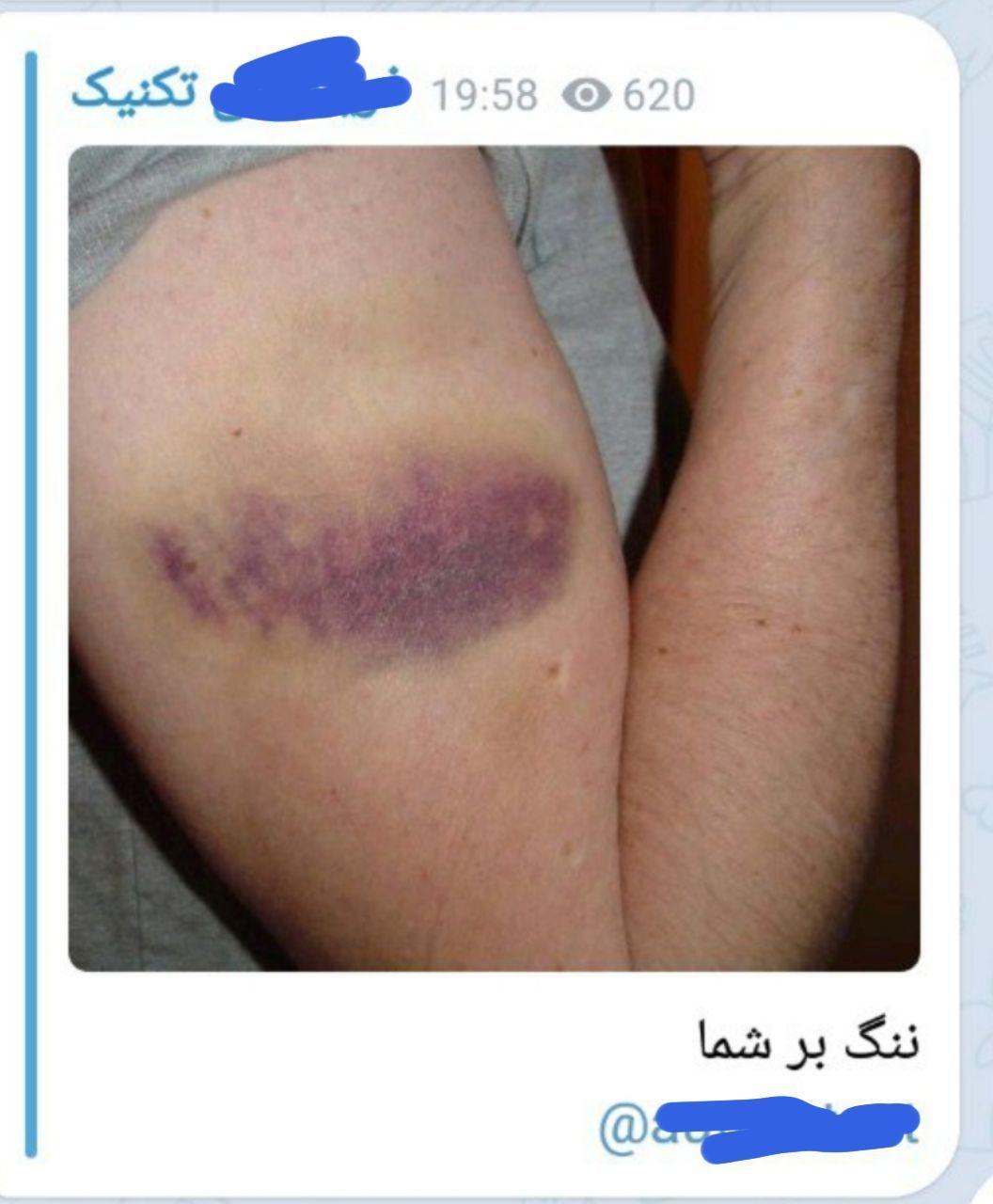 پروژه خشونت سازی اینبار با تصاویر مسدومیت کشتی گیر ایرانی