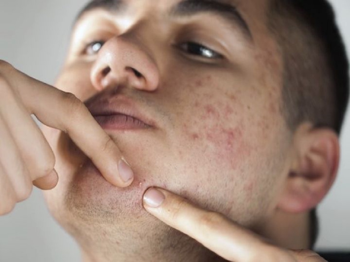 جوش زدن هر ناحیه از صورت نشانه چه بیماری است؟