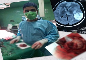 اولین جراحی تومور مغزی در بیمارستان بوکان انجام شد