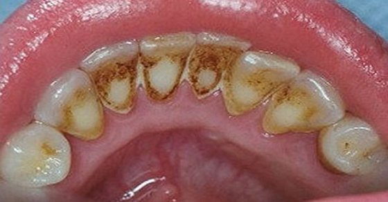 عوامل تاثیرگزار بر رنگ دندان ها 