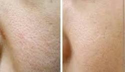 با منافذ باز پوست چه کنم؟