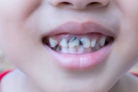 برای جلوگیری از پوسیدگی دندان چه باید کرد؟