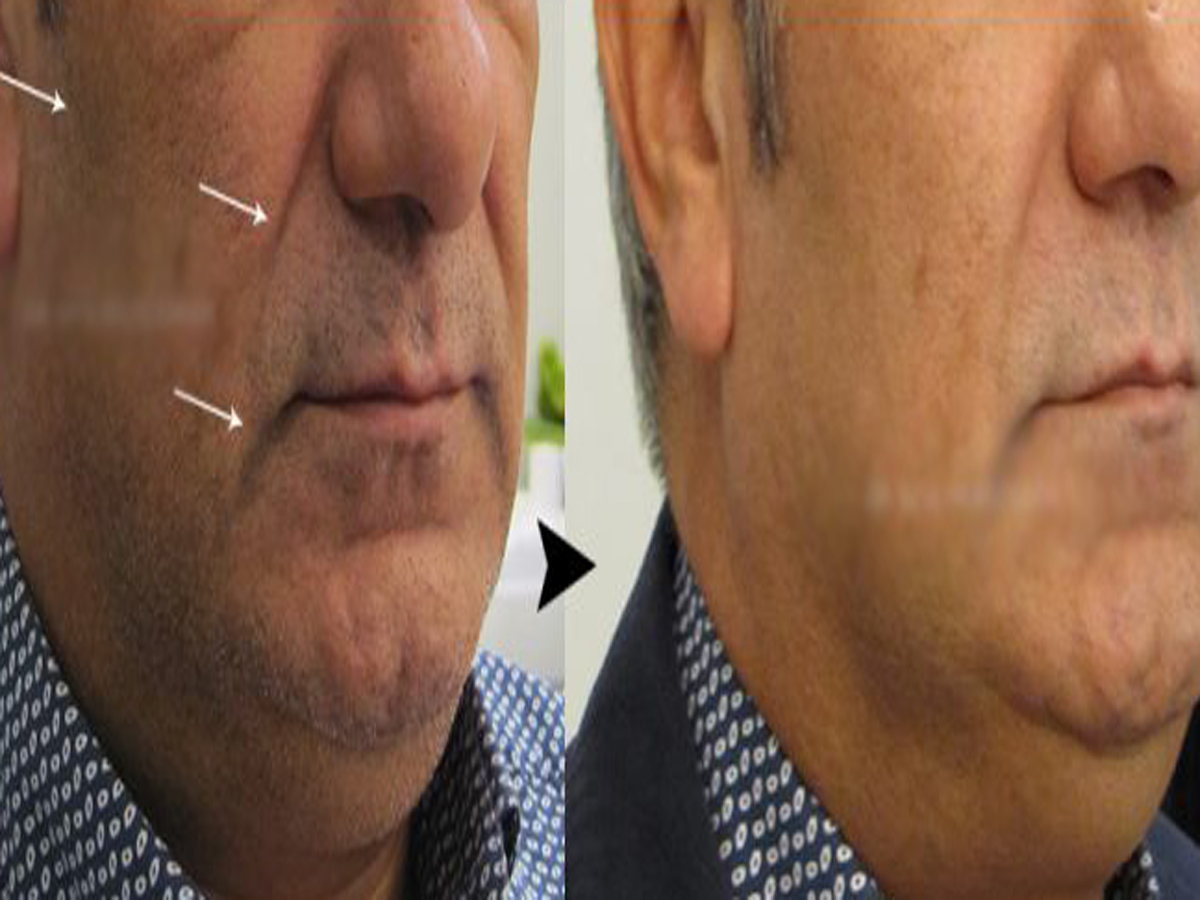 لیفت گونه؛ زیبایی و اعتمادبه‌نفس را تجربه کنید