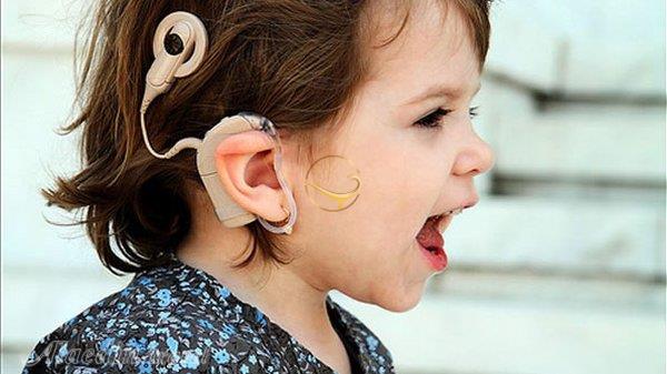 کاهش قیمت کاشت حلزون بازگشت شنوایی را دو چندان کرد