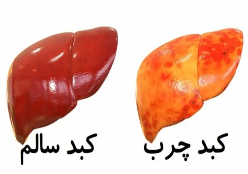 آیا کودکان هم به کبد چرب مبتلا میشوند؟ / این بیماری مدرن را بیشتر بشناسید آیا کودکان هم به کبد چرب مبتلا میشوند؟ / این بیماری مدرن را بیشتر بشناسید