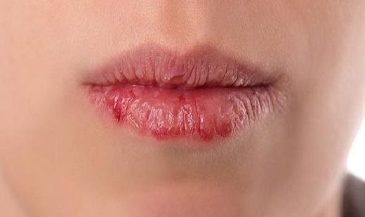 جوش زدن هر ناحیه از صورت نشانه چه بیماری است؟