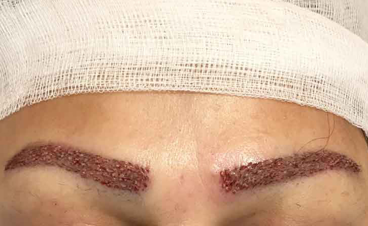 علت خارش محل کاشت ابرو چیست؟